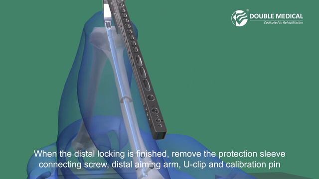Double Medical Universal Cannulated Tibial Nail （UTN） II смотреть онлайн