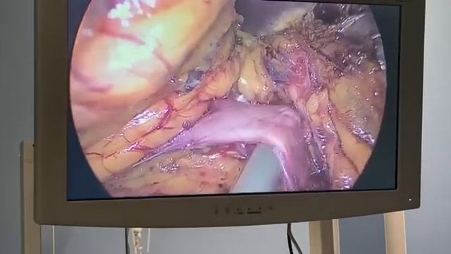 Лапароскопическая нефрэктомия #урология #ташкент смотреть онлайн