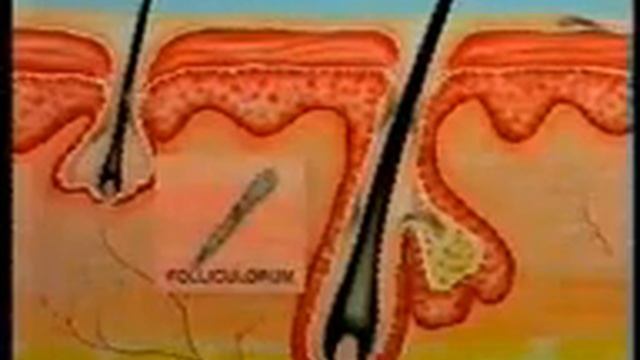 video clip where demodex found смотреть онлайн