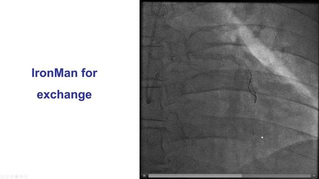 5.11 Manual of PCI - How to exchange catheters over a 300 cm long supportive 0.014 inch guidewire смотреть онлайн