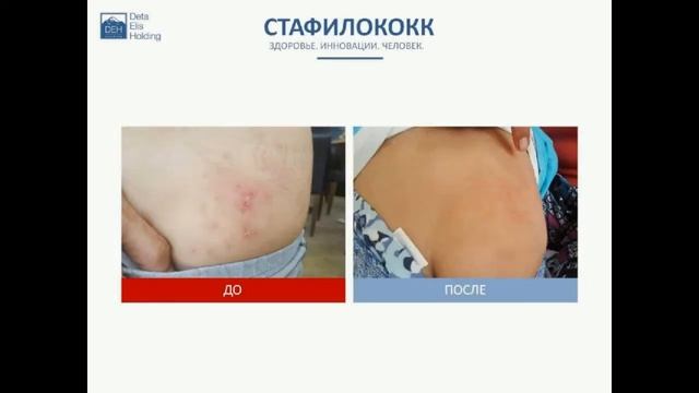 Результаты оздоровления. Биорезонанс. смотреть онлайн