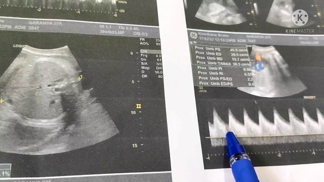 Gender Predict Using Scan Reports In Tamil/ How To Find Boy Or Girl Scan Report/ramsaran Channel