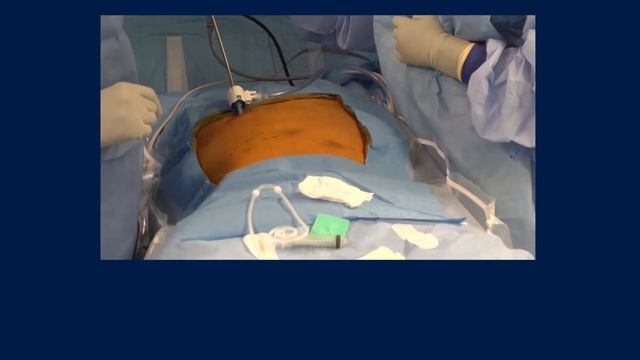 Peritoneal Dialysis Video: Laparoscopic Insertion Technique | Medtronic смотреть онлайн