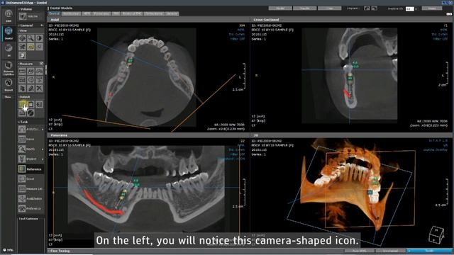 Dental module - Implant simulation Part 2 смотреть онлайн