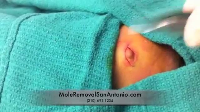 Best facial mole removal San Antonio смотреть онлайн