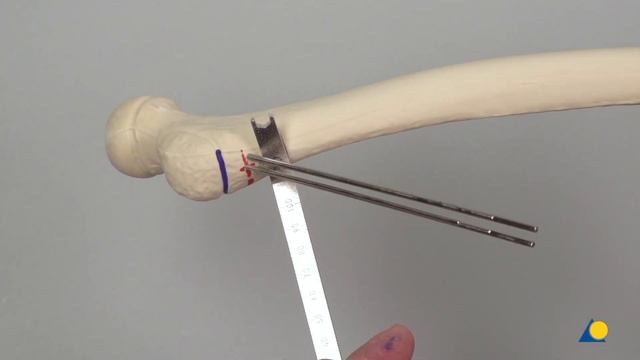 Femur, Proximal—Valgus Deformity—Varus Osteotomy and Fixation Using the LCP Pediatric Hip Plate смотреть онлайн