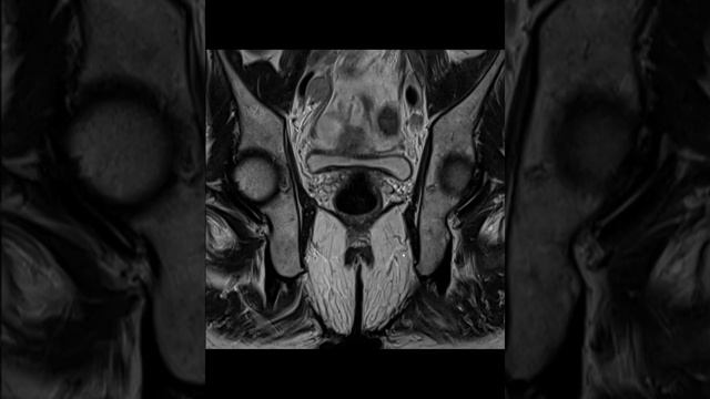 Metastatic prostate adenocarcinoma - plain MRI pelvis #TheReportingRoom смотреть онлайн
