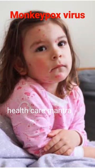 monkeypox virus क्या है? #shorts #ytshorts #monkeypoxcases смотреть онлайн