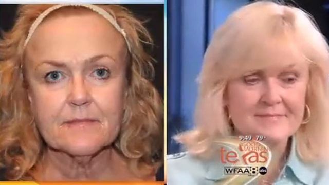Smartxide Dot Therapy Results, Thermage Results | Anti Wrinkle | Cosmetic Surgery