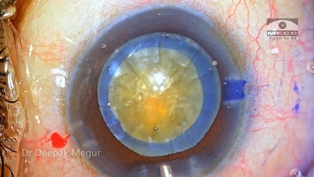 Cataract Vlog-12 . Intumescent Cataract and 2 Stage rhexis & Phacoemulsification - Dr Deepak Megur
