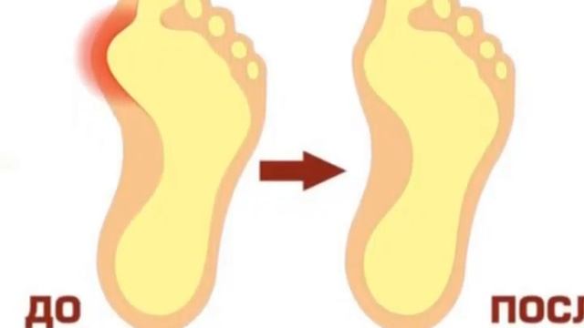 Фиксатор Valgus Pro смотреть онлайн
