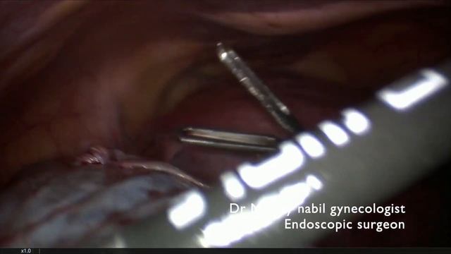 Para ovarian cystectomy on 20 weeks pregnancy смотреть онлайн