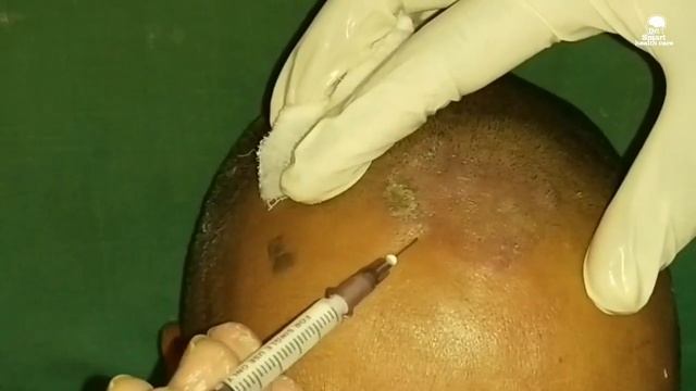 Tinea capitis fungal infection treatment, смотреть онлайн