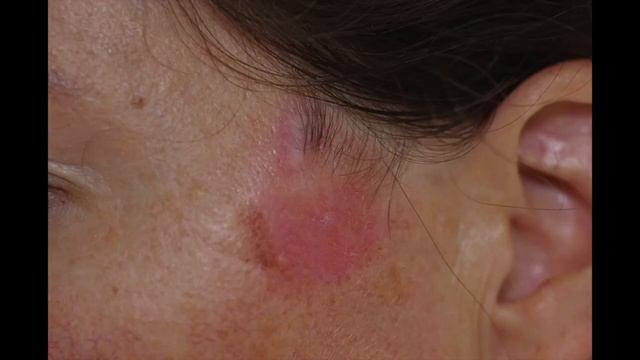What to do with Skin Cancer BCC? // Curaderm BCC смотреть онлайн