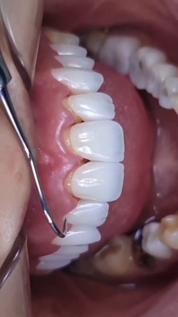 ВИНИРЫ. Стоматолог Краснодар. делаем красивые зубы