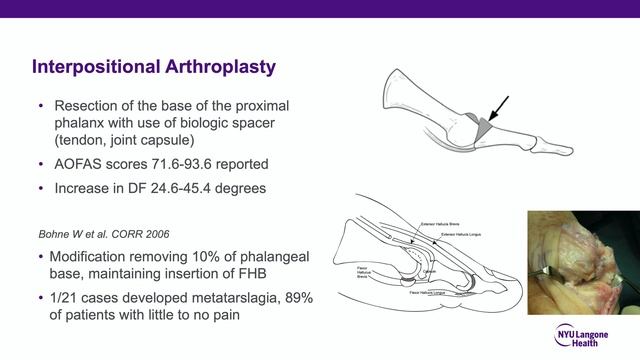 Hallux Rigidus - ABOS Orthopedic Surgery Board Exam Review