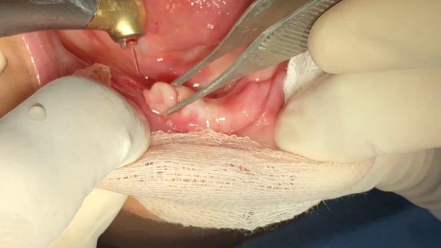 BIOLASE LASER ASSISTED SOFT TISSUE MANAGEMENT смотреть онлайн