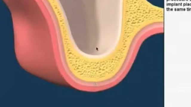 Sinus Lift and implant fixing смотреть онлайн