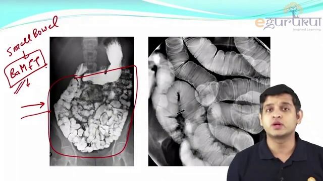 FMGE | Ba. Meal Follow Through | Radiology | Dr. Rajat Jain | DBMCI | eGurukul смотреть онлайн