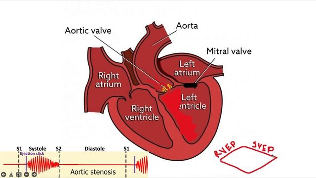 Aortic Stenosis and the midsystolic crescendo-decrescendo ejection murmur смотреть онлайн