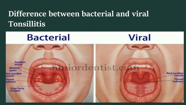 ENT/Pathophysiology of Tonsillitis/3rd MBBS/important questions смотреть онлайн