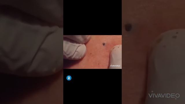 Застаревшая черная точка на лице смотреть онлайн