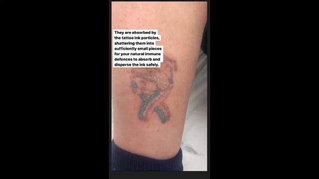 Laser tattoo removal смотреть онлайн