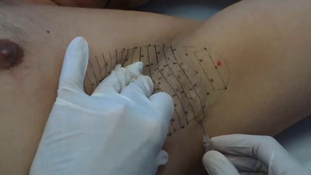 *Medical Procedure* Numbing Technique for miraDry смотреть онлайн