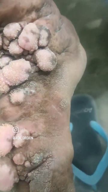 #Elephantasis_Nostra_Verrucosa #wucheria_bancrofti #secondary_Cutaneous_Changes #Filariasis смотреть онлайн