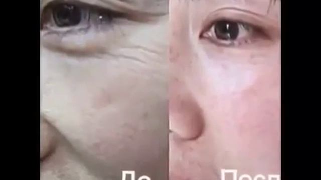 Результаты применения продукции Jeunesse! До и После смотреть онлайн