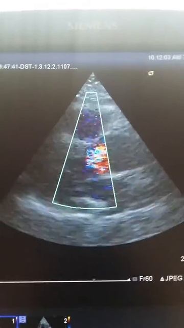 Аортальная регургитация смотреть онлайн