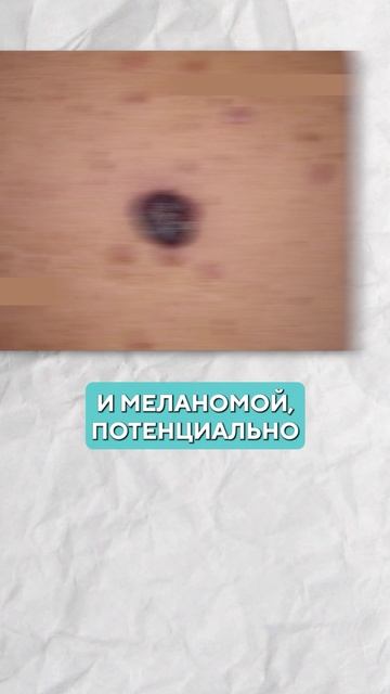 БЕСПОКОЯТ ПИГМЕНТНЫЕ УСИКИ? Есть решение! #косметология #красота #пигментация смотреть онлайн