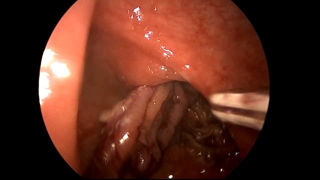 TAMIS - Transanal minimally invasive surgery narrated смотреть онлайн