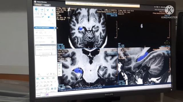 MRI HIPPOCAMPUS VOLUMERTY смотреть онлайн