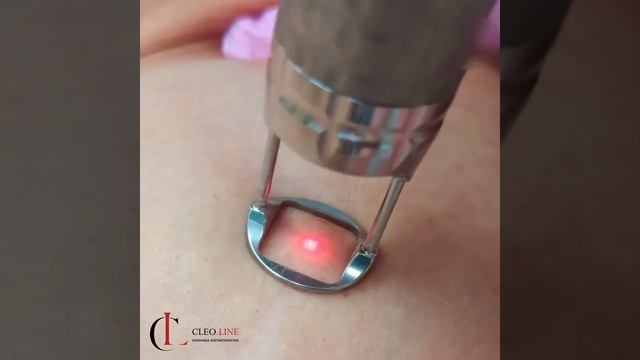 Лечение шрамов смотреть онлайн