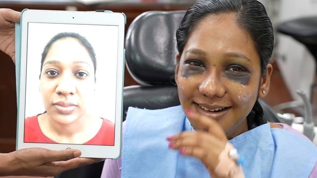 Young Girl Facial Plastic Surgery in India - Day 7 - Nose Pack Removal смотреть онлайн