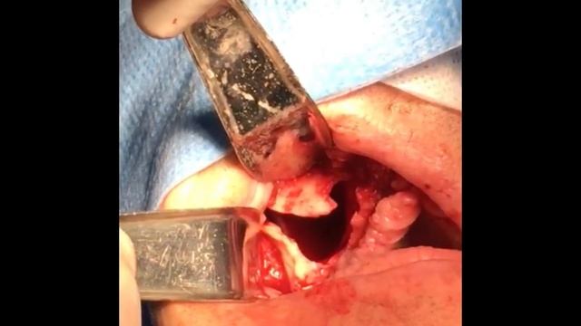 ZIGOMA IMPLANT INFECTION EXPLANTATION AND RECONSTRUCTION смотреть онлайн