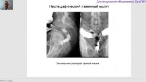 Классическая рентгенологическая диагностика заболеваний толстой кишки. Лектор Бурмистров М.А.