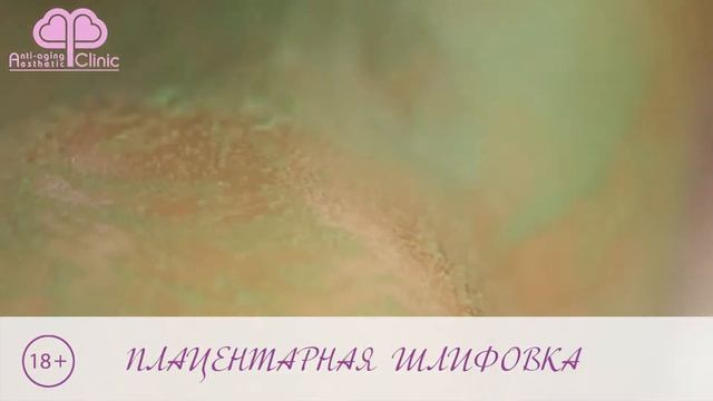 плацентарная шлифовка смотреть онлайн