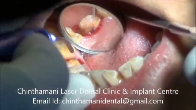 Gingival Troughing using Zolar Diode Laser in India смотреть онлайн