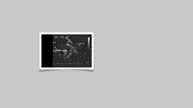 Transesophageal Echo, TEE ( Mitral Valve Apparatus) смотреть онлайн