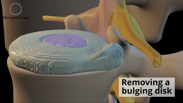 Signs and Symptoms of Spinal Stenosis смотреть онлайн