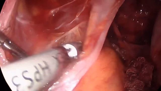 Laparoscopic Peritonectomy for deep infiltrating endometriosis смотреть онлайн
