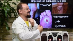 Как избавиться от варикозного расширения вен, вылечить тромбофлебит и убрать отеки