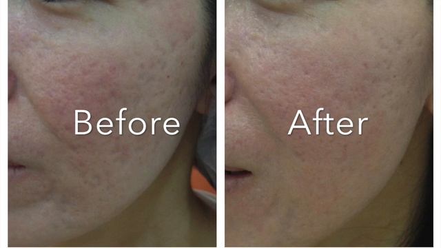 【Scar】New Approach of Scar Treatment смотреть онлайн