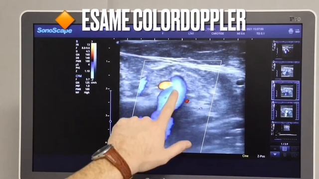 Cos'è e a cosa serve l'ecocolorDoppler смотреть онлайн