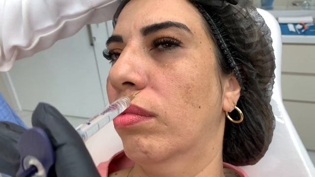 PREENCHIMENTO DE BIGODE CHINÊS | procedimento completo no sulco nasogeniano e fossa piriforme смотреть онлайн