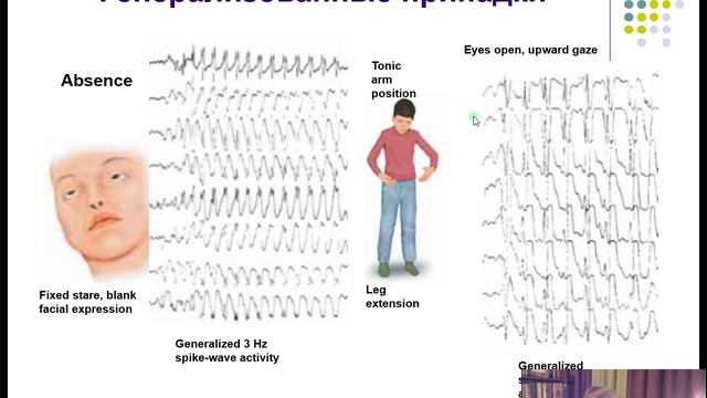 Эпилепсия. Эпилептический статус. смотреть онлайн