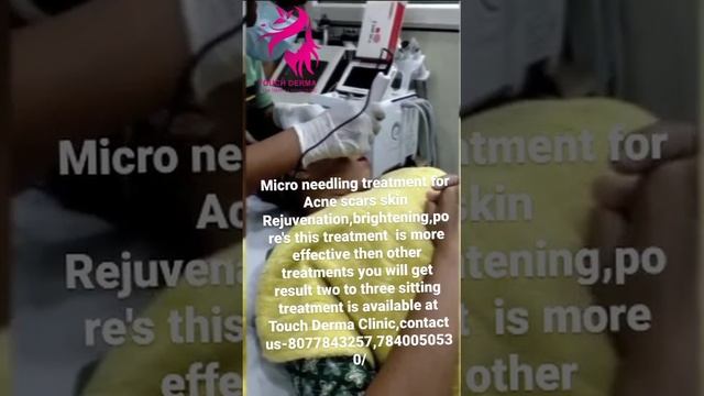 Micro needling treatment for Acne scars skin at Touch Derma Clinic, us-8077843257,7840050530 смотреть онлайн