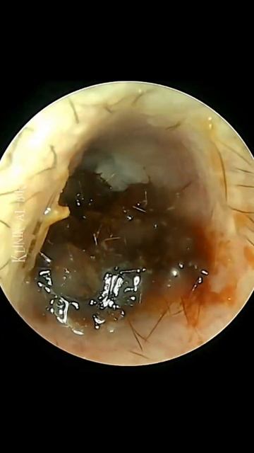 EARWAX THAT SAVE THE DAY смотреть онлайн